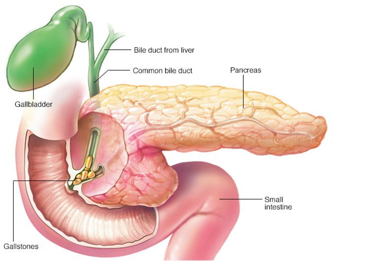 Understanding Median Arcuate Ligament Compression Syndrome: Rare but  Persistent Cause of Pain in Upper Tummy - Dr AvinashTank, is a  super-specialist (MCh) Laparoscopic Gastro-intestinal Surgeon