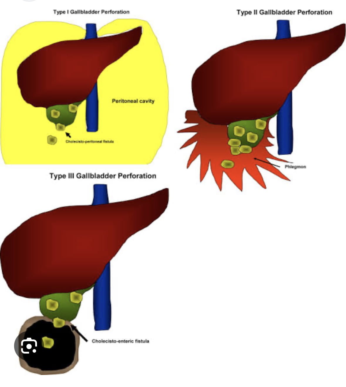 Gallbladder Perforation Causes Treatment And Prevention Dr