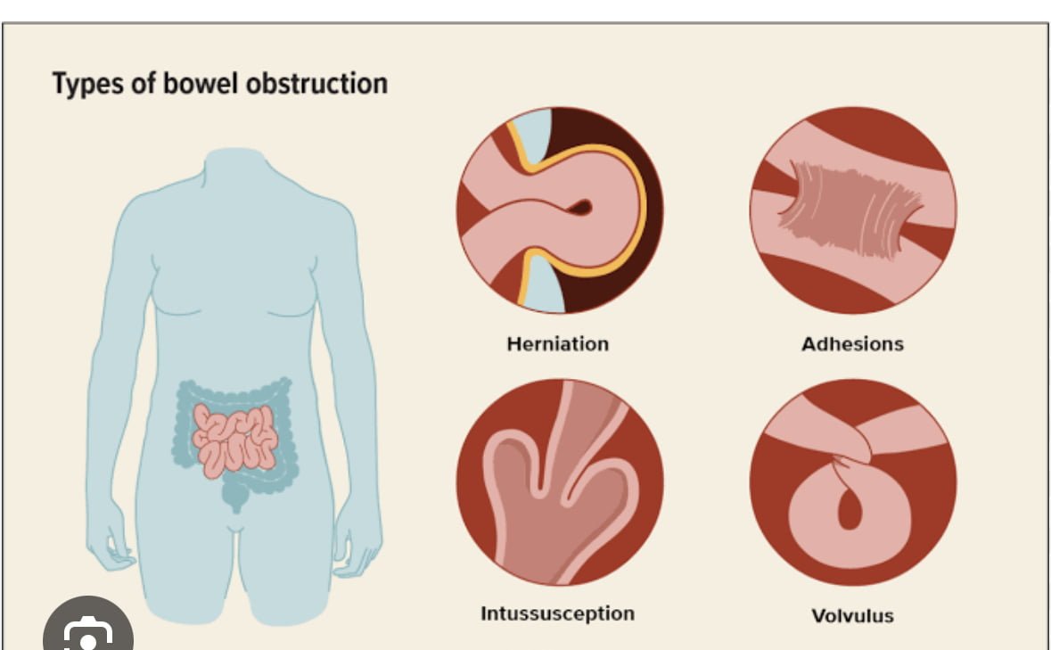 Small Bowel Obstruction: Causes, Symptoms & Treatment. - Dr AvinashTank, is  a super-specialist (MCh) Laparoscopic Gastro-intestinal Surgeon