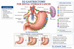 D2 Radical Distal Gastrectomy for Gastric Cancer.