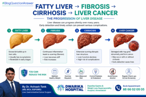 10-word ALT text: Fatty liver progression from fibrosis and cirrhosis to liver cancer