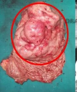 Distal gastrectomy specimen demonstrating a large Gastric Gastrointestinal Stromal Tumor (GIST) following surgical resection.