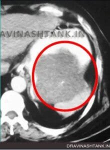 Contrast-enhanced CT scan showing a large Gastric GIST arising from the distal stomach