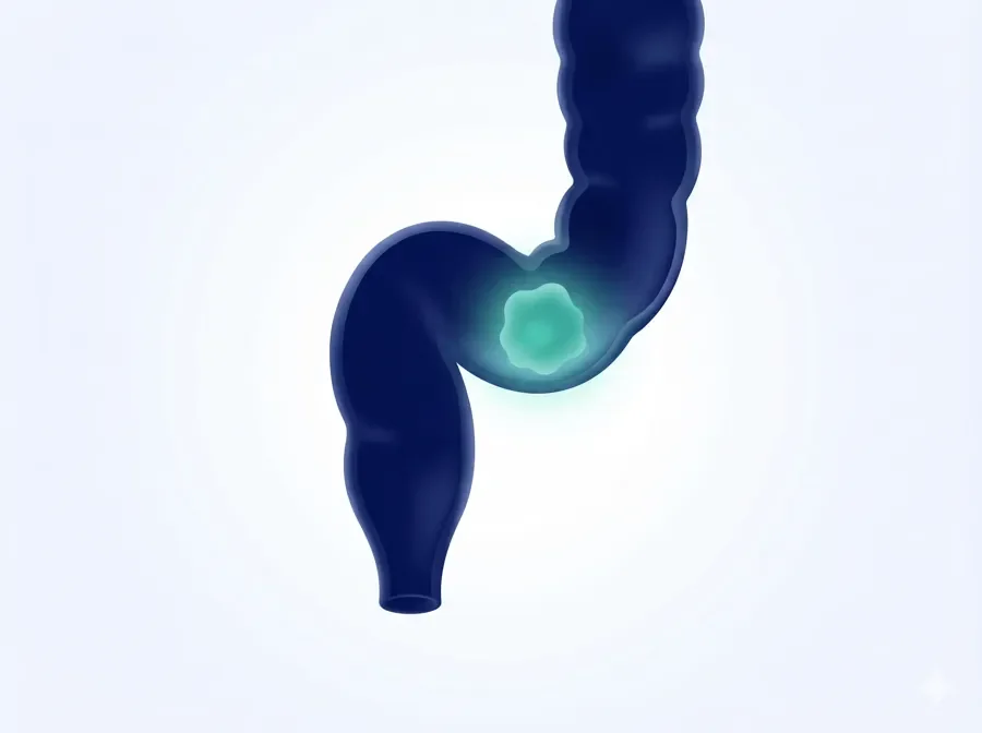 Colon Cancer
