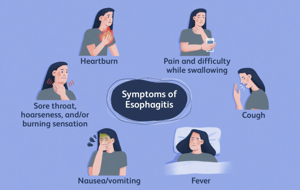 Esophagitis- Causes, Diagnosis, Treatment and Prevention
