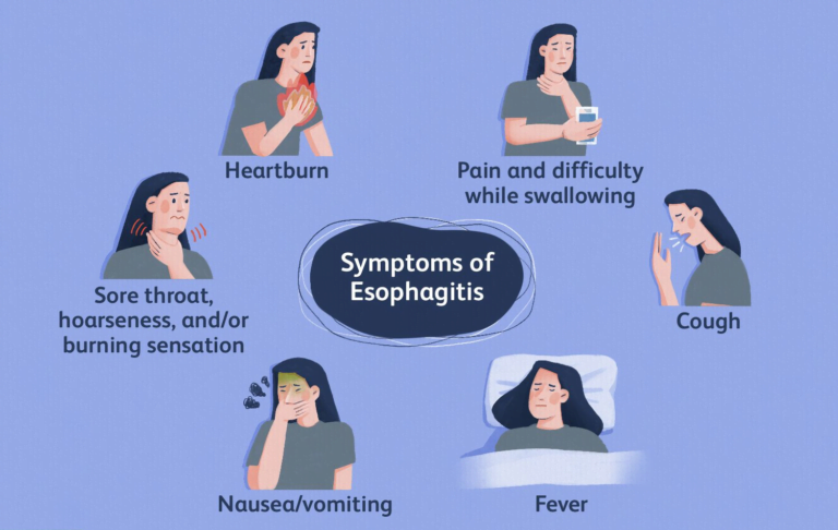 Esophagitis- Causes, Diagnosis, Treatment and Prevention