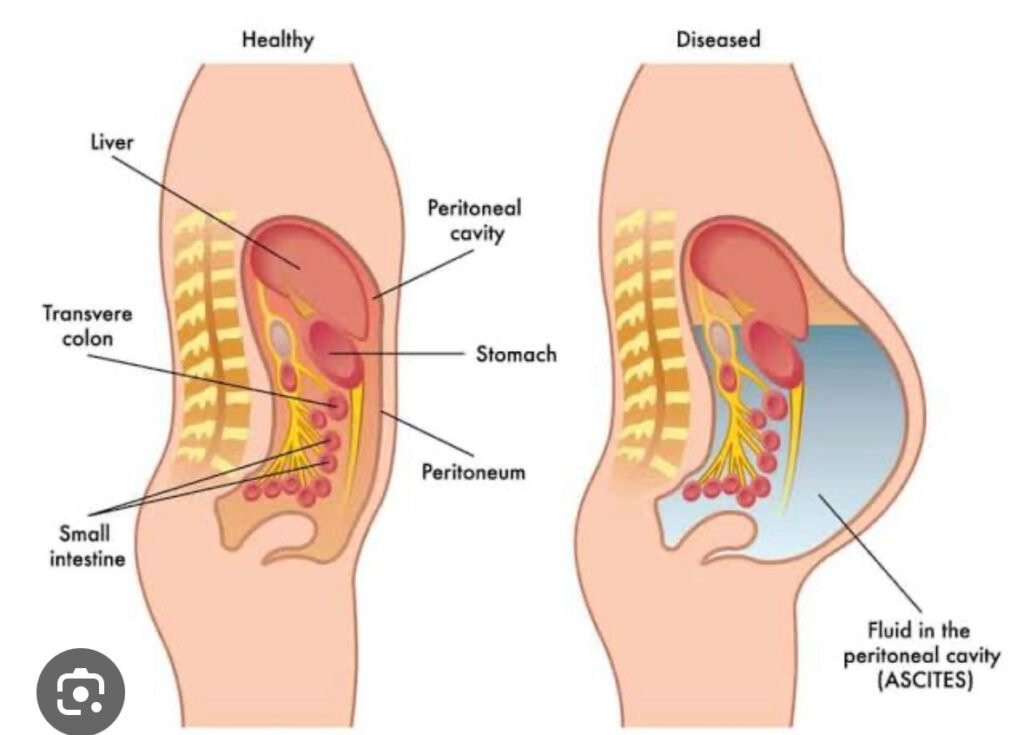 Ascites treatment cost in India