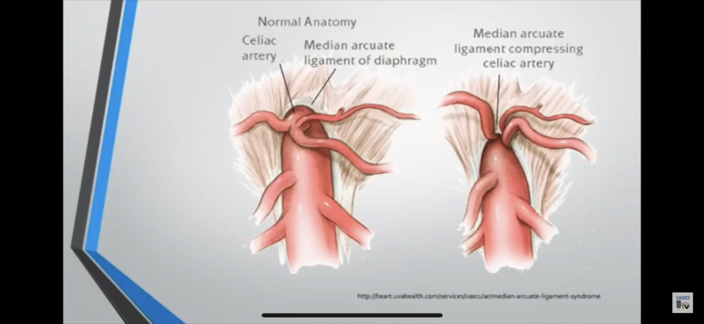 Understanding Median Arcuate Ligament Compression Syndrome: Rare but Persistent Cause of Pain in Upper Tummy