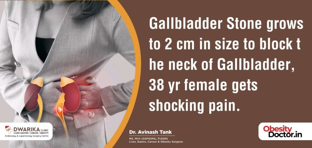 Gallbladder Stone grows to 2 cm in size to block the neck of Gallbladder, 38 yr female gets shocking pain.