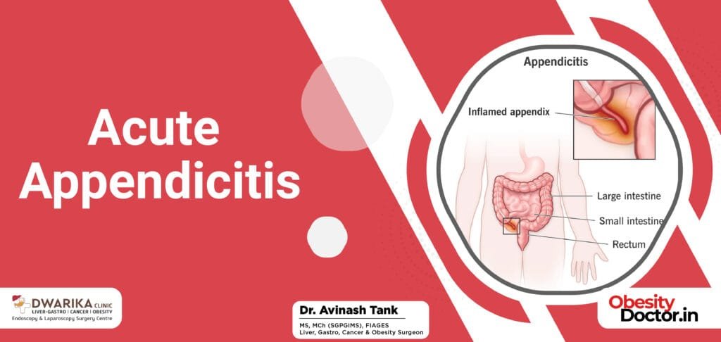 Acute Appendicitis