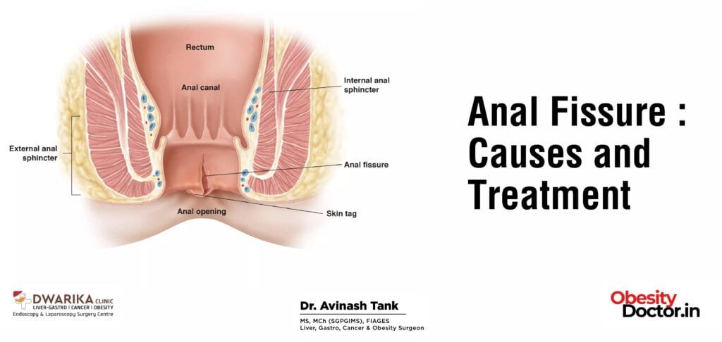 Anal Fissure: Causes and Treatment