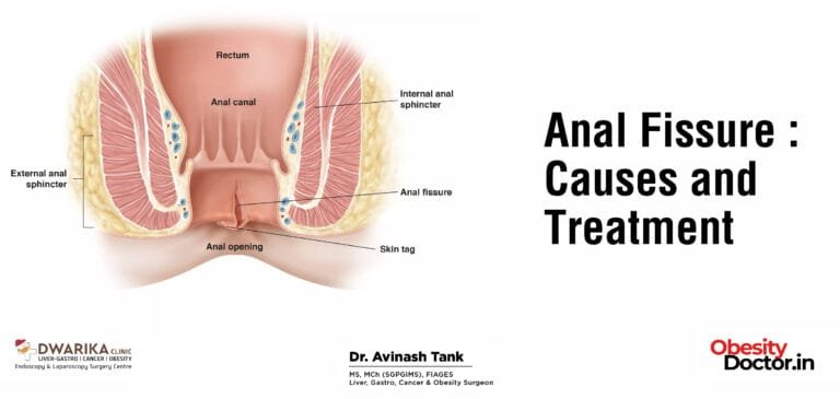 Anal Fissure: Causes and Treatment