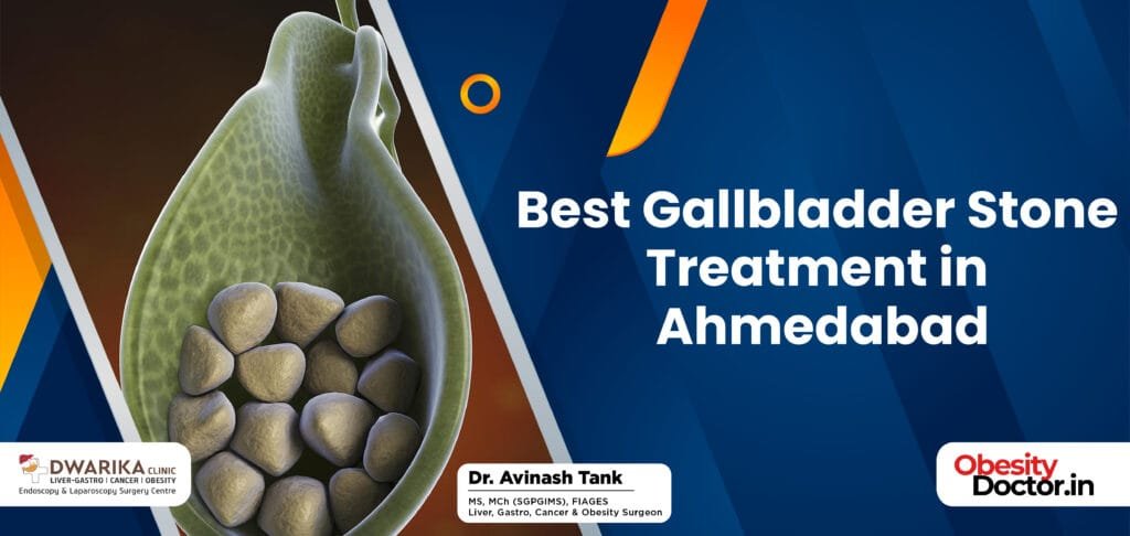 Best Gallbladder Stone Treatment in Ahmedabad
