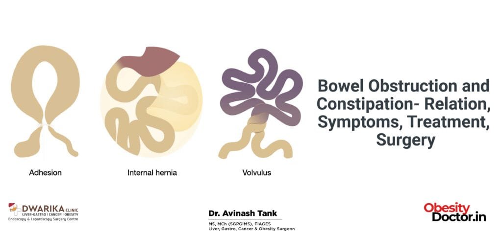 Bowel Obstruction and Constipation- Relation, Symptoms, Treatment, Surgery
