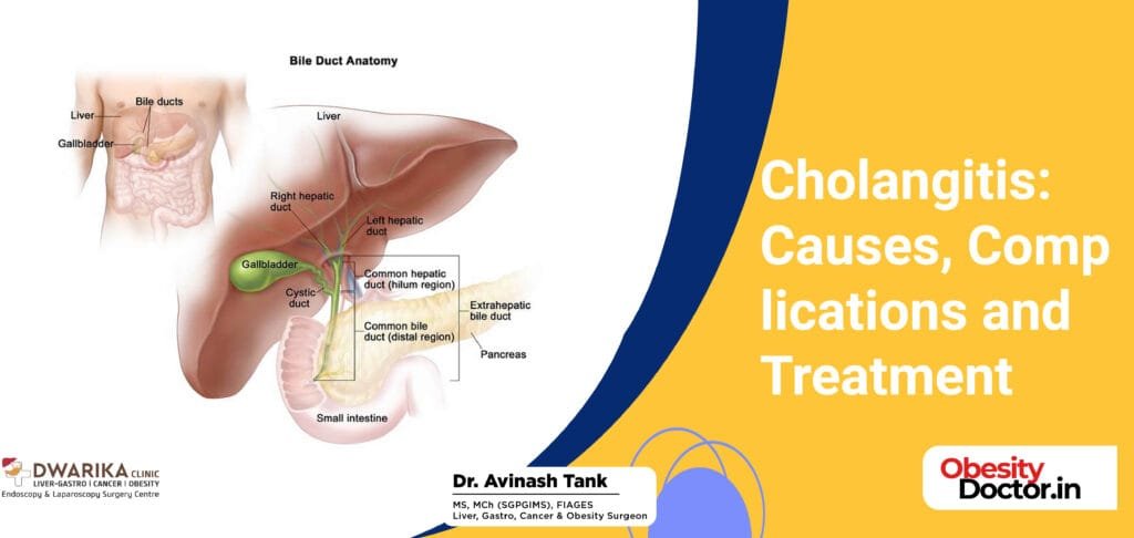 Cholangitis: Causes, Complications and Treatment