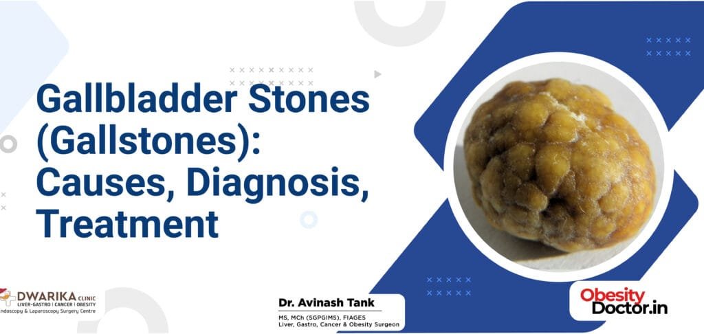 Gallbladder Stones (Gallstones): Causes, Diagnosis, Treatment