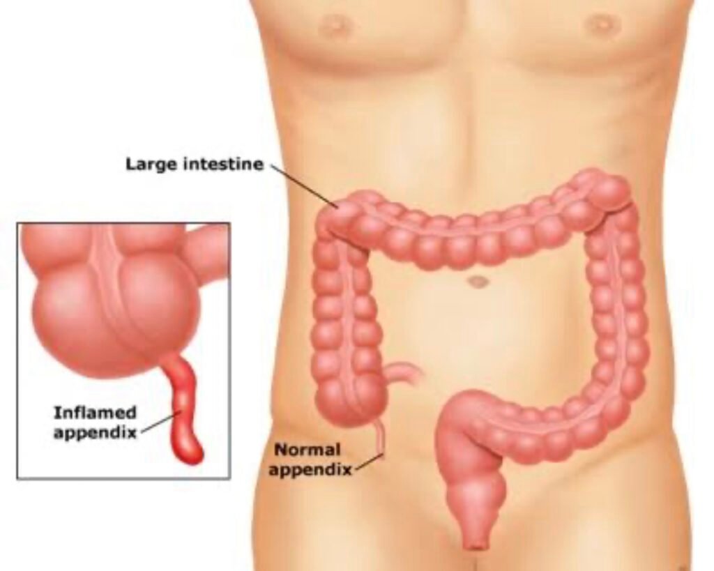 Appendix Treatment in Bopal, Ahmedabad