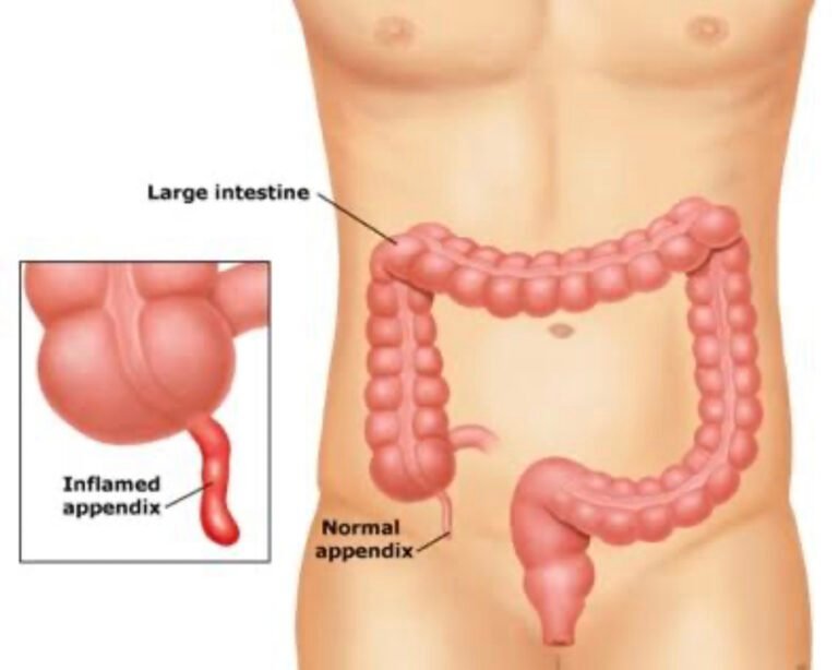 Appendix Treatment in Bopal, Ahmedabad