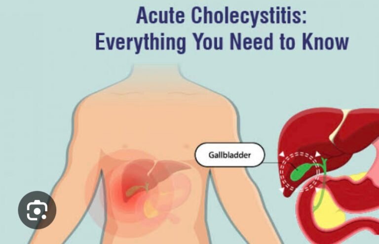 Acute Calculus Cholecystitis
