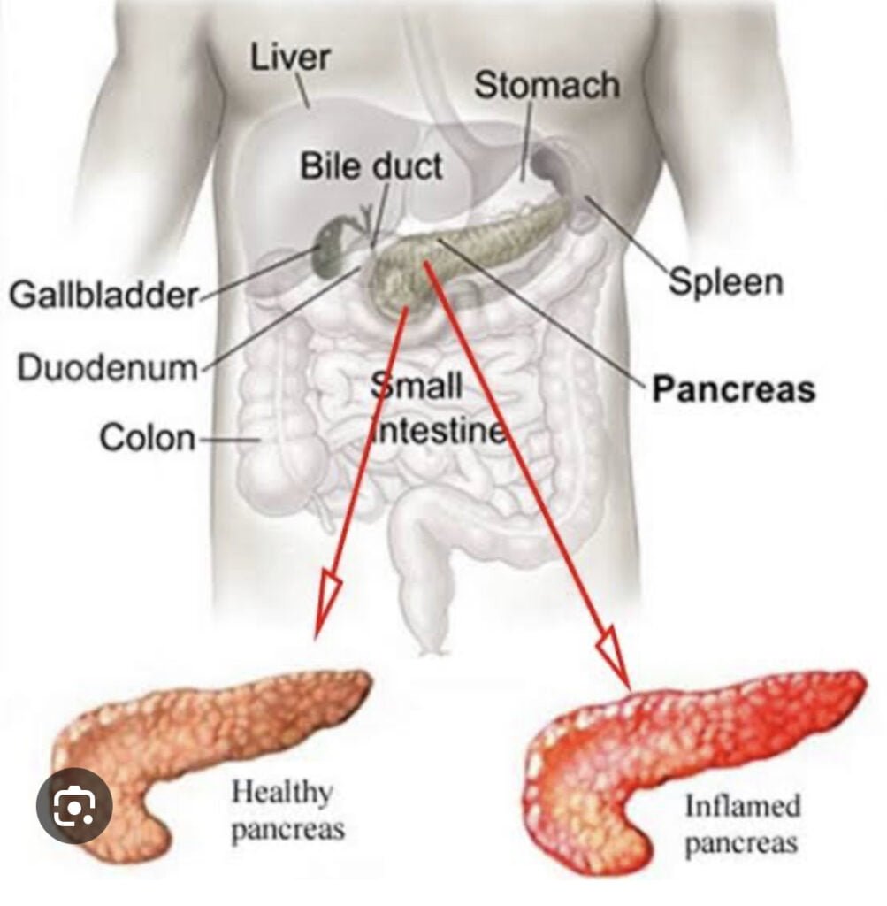 Acute Pancreatitis Causes Symptoms Diagnosis