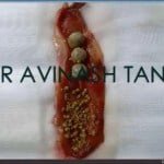 Natural Ways to Dissolve a 20 mm Gallstone: Myth or Reality?