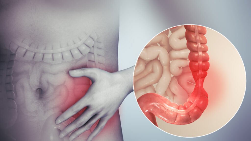 Irritable Bowel Syndrome (IBS) and Constipation