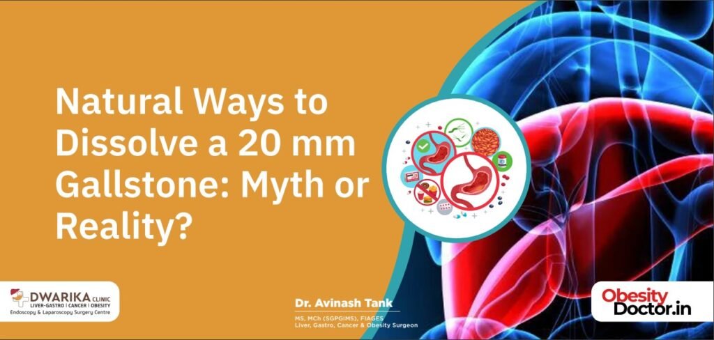 Natural Ways to Dissolve a 20 mm Gallstone: Myth or Reality?