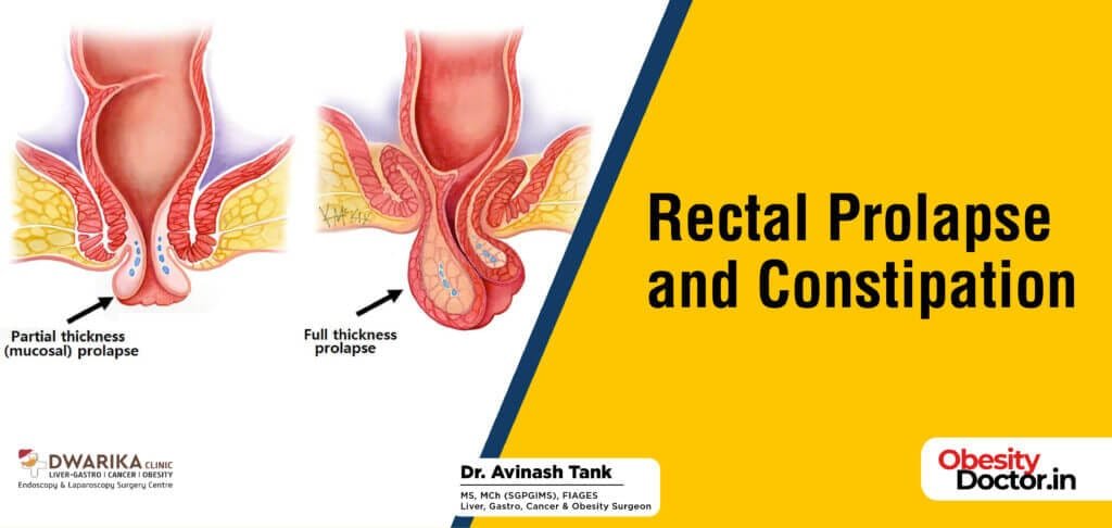 Rectal Prolapse and Constipation