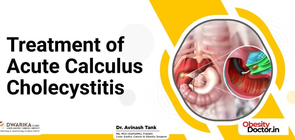 Treatment of Acute Calculus Cholecystitis