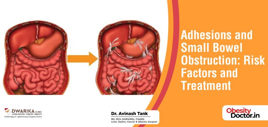Adhesions and Small Bowel Obstruction:Risk Factors and Treatment