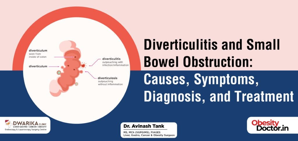 Diverticulitis and Small Bowel Obstruction: Causes, Symptoms, Diagnosis, and Treatment
