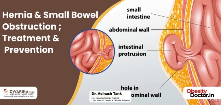 Hernia & Small Bowel Obstruction; Treatment & Prevention.