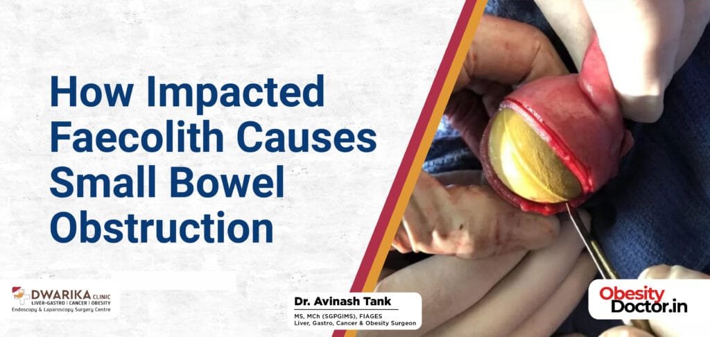 How Impacted Faecolith Causes Small Bowel Obstruction