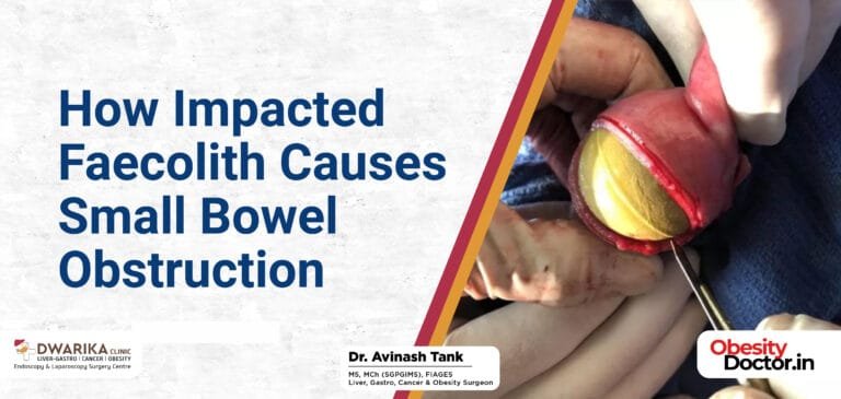 How Impacted Faecolith Causes Small Bowel Obstruction