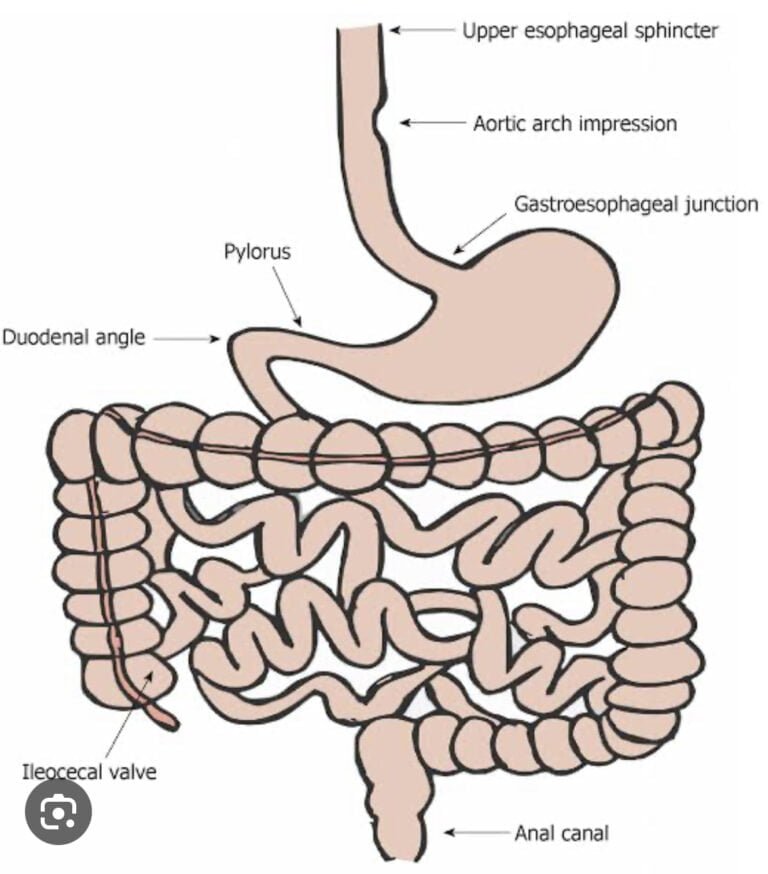 Foreign Bodies and Small Bowel Obstruction: Causes, Symptoms, and Treatment