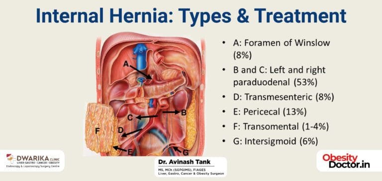 Internal Hernia: Types & Treatment.