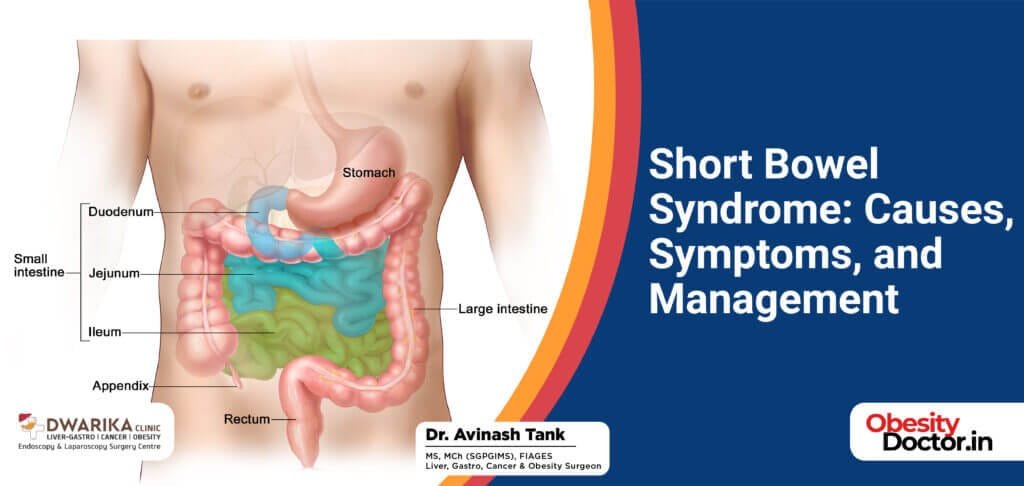 Short Bowel Syndrome: Causes, Symptoms, and Management