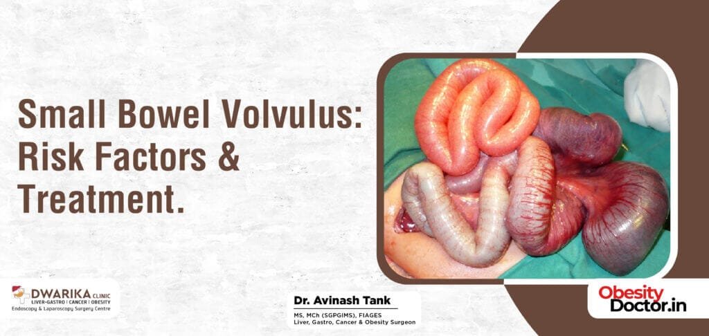 Small Bowel Volvulus: Risk Factors & Treatment.