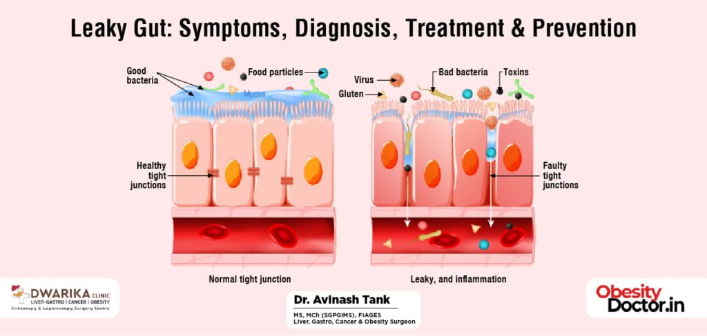 Leaky Gut: Symptoms, Diagnosis, Treatment & Prevention