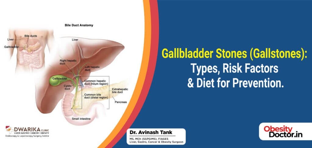 Gallbladder Stones (Gallstones): Types Risk Factors & Diet for Prevention.