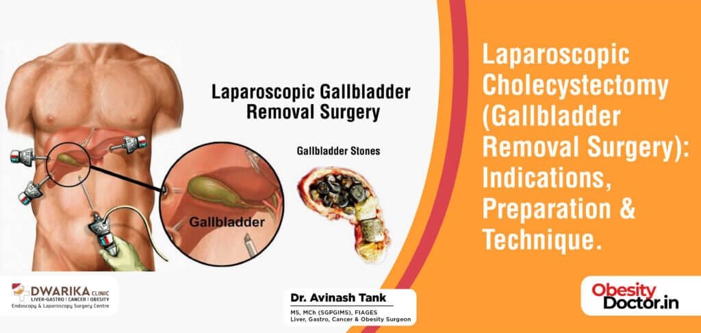 Laparoscopic Cholecystectomy ( Gallbladder Removal Surgery): Indications, Preparation & Technique.