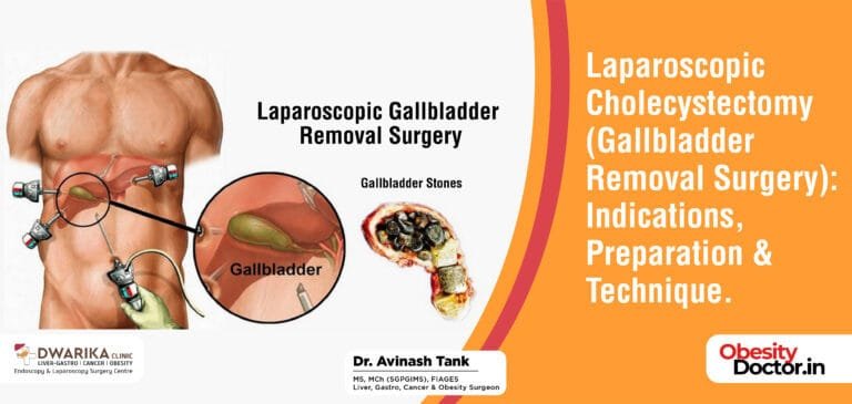 Laparoscopic Cholecystectomy ( Gallbladder Removal Surgery): Indications, Preparation & Technique.