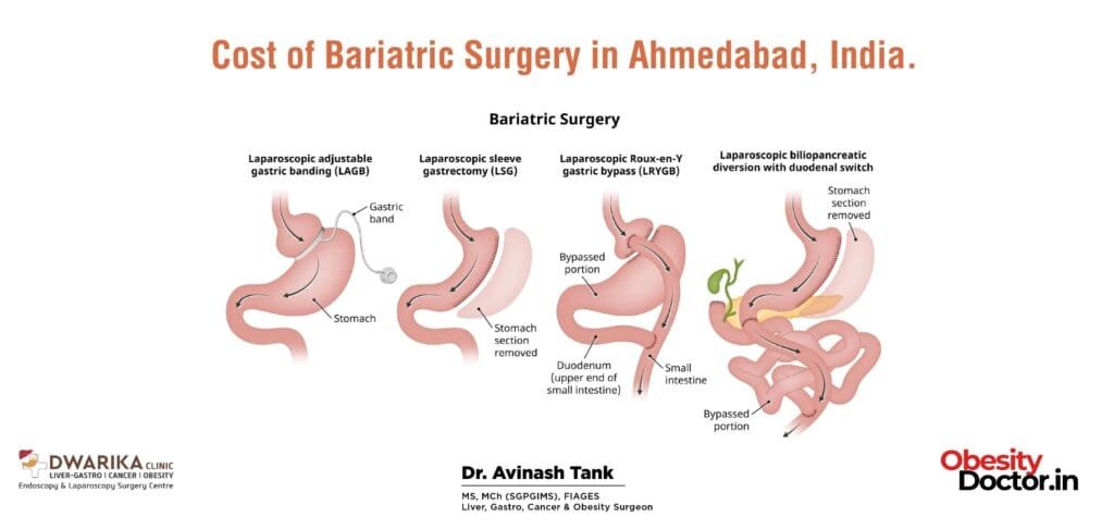 Cost of Bariatric Surgery in Ahmedabad, India.
