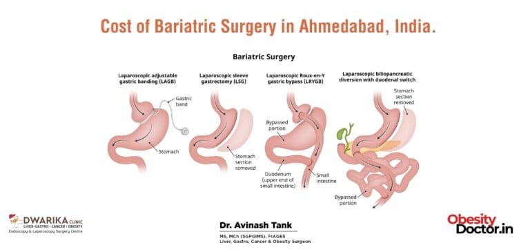 Cost of Bariatric Surgery in Ahmedabad, India.
