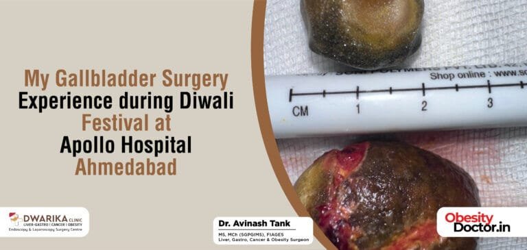 My Gallbladder Surgery Experience during Diwali Festival at Apollo Hospital Ahmedabad.