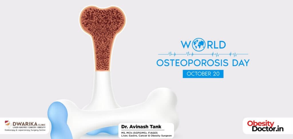 World Osteoporosis Day: Myths and Facts about Bone Health