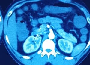 Pancreas NET CT Findings