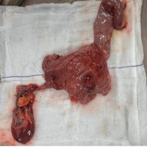 Resected Specimen of Whipples Pancreatido-duodenectomy