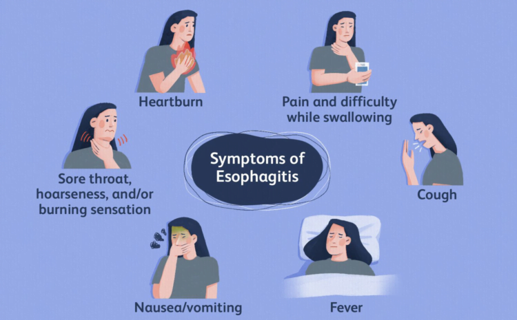 Infographic about symptoms of Esophagitis