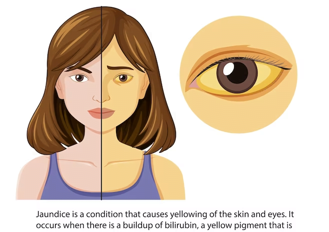 Drawing showing the symptoms of jaundice along with definition
